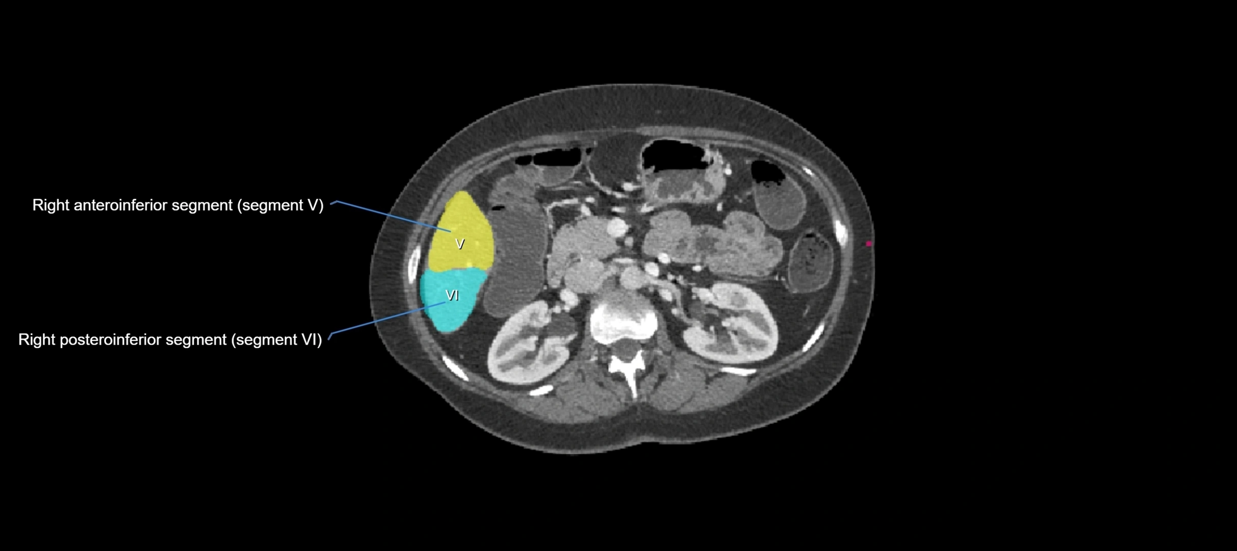 CT liver segments axial cross sectional anatomy labelled image-00023.webp